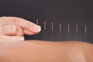 Acupuncture needs on skin