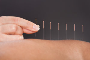5 Benefits of Acupuncture For Those in Addiction Recovery